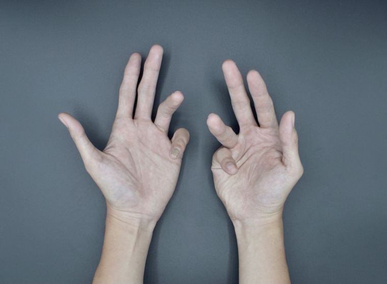 Dupuytren's disease of the hand