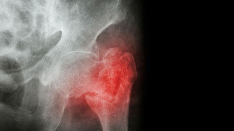 X-ray of a hip fracture