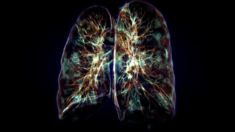 lungs infected with covid 19 in red and green colors