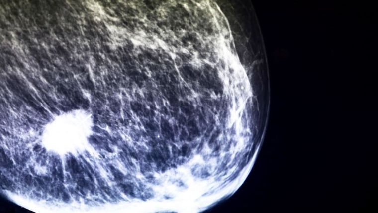 Mammogram showing breast cancer tumour